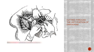 CUTTING THROUGH
THE LEFT PORTION OF
DIAPHGRAM
 