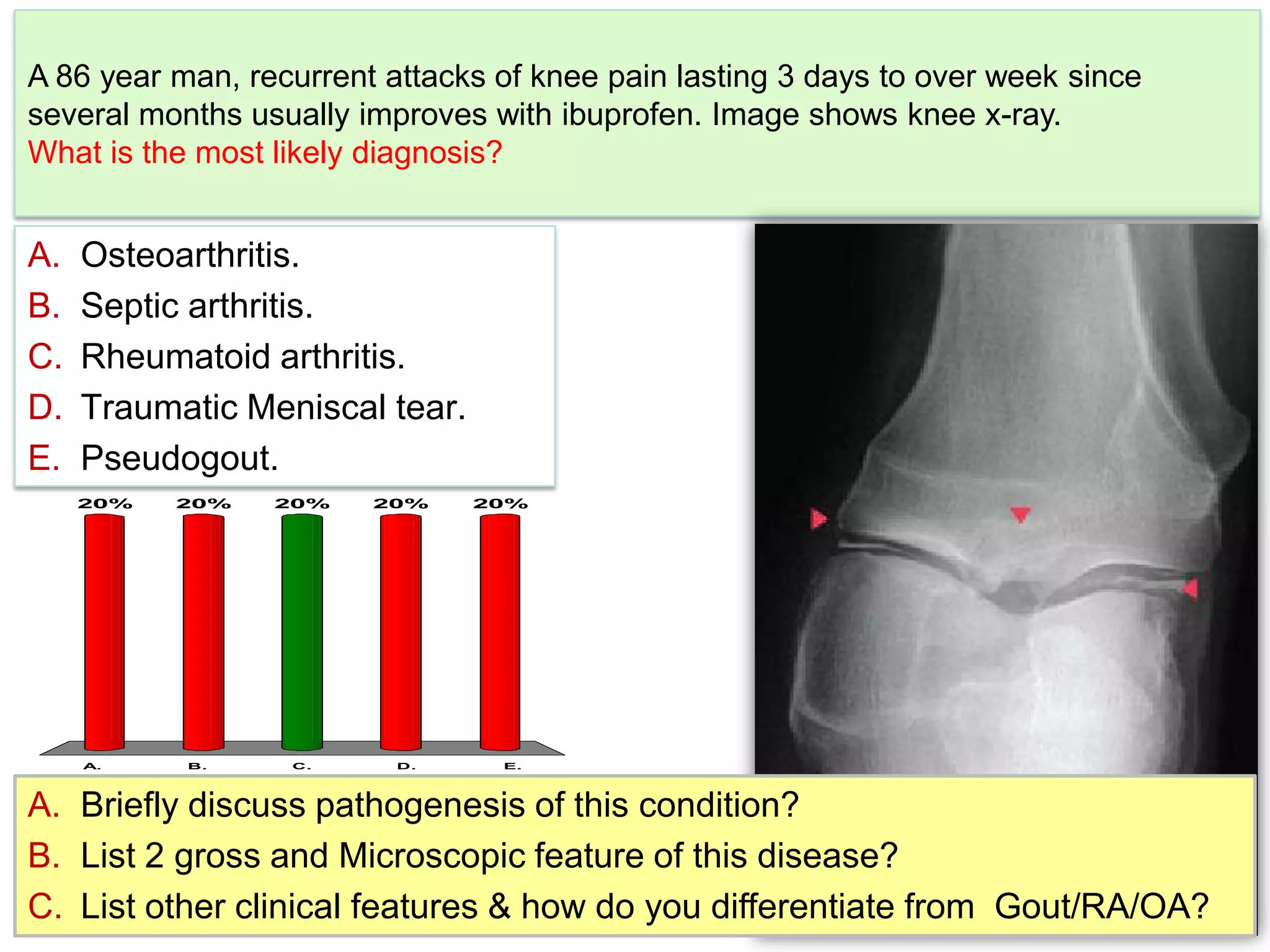 A 86 year man, recurrent attacks of knee pain lasting 3 days to over week since several months usually improves with ibuprofen. Image shows knee x-ray. What is the most likely diagnosis?Osteoarthritis.Septic arthritis.Rheumatoid arthritis.Traumatic Meniscal tear.Pseudogout.Briefly discuss pathogenesis of this condition?List 2 gross and Microscopic feature of this disease?List other clinical features & how do you differentiate from  Gout/RA/OA?