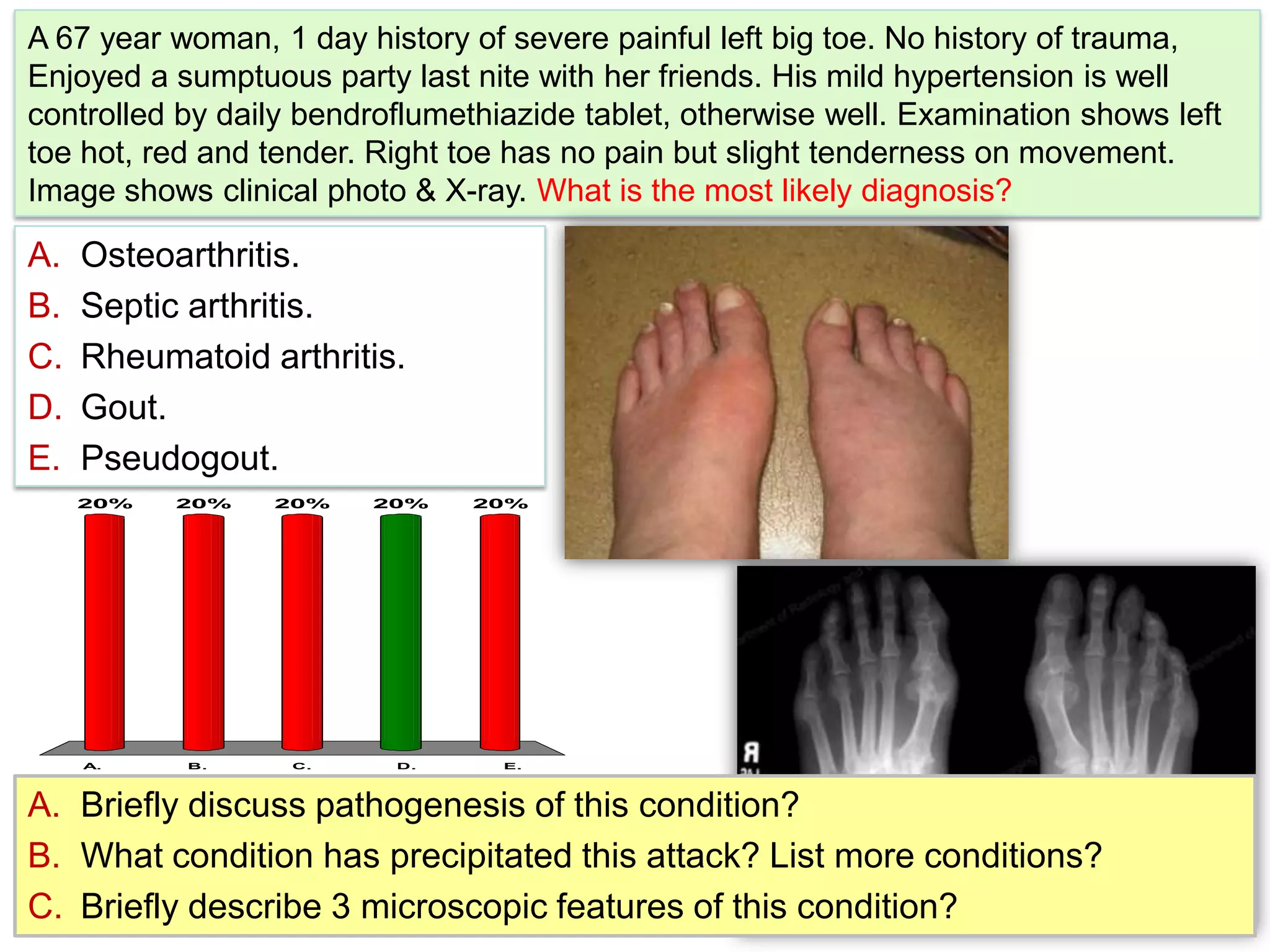 A 67 year woman, 1 day history of severe painful left big toe. No history of trauma, Enjoyed a sumptuous party last nite with her friends. His mild hypertension is well controlled by daily bendroflumethiazidetablet, otherwise well. Examination shows left toe hot, red and tender. Right toe has no pain but slight tenderness on movement. Image shows clinical photo & X-ray. What is the most likely diagnosis?Osteoarthritis.Septic arthritis.Rheumatoid arthritis.Gout.Pseudogout.Briefly discuss pathogenesis of this condition?What condition has precipitated this attack? List more conditions?Briefly describe 3 microscopic features of this condition?