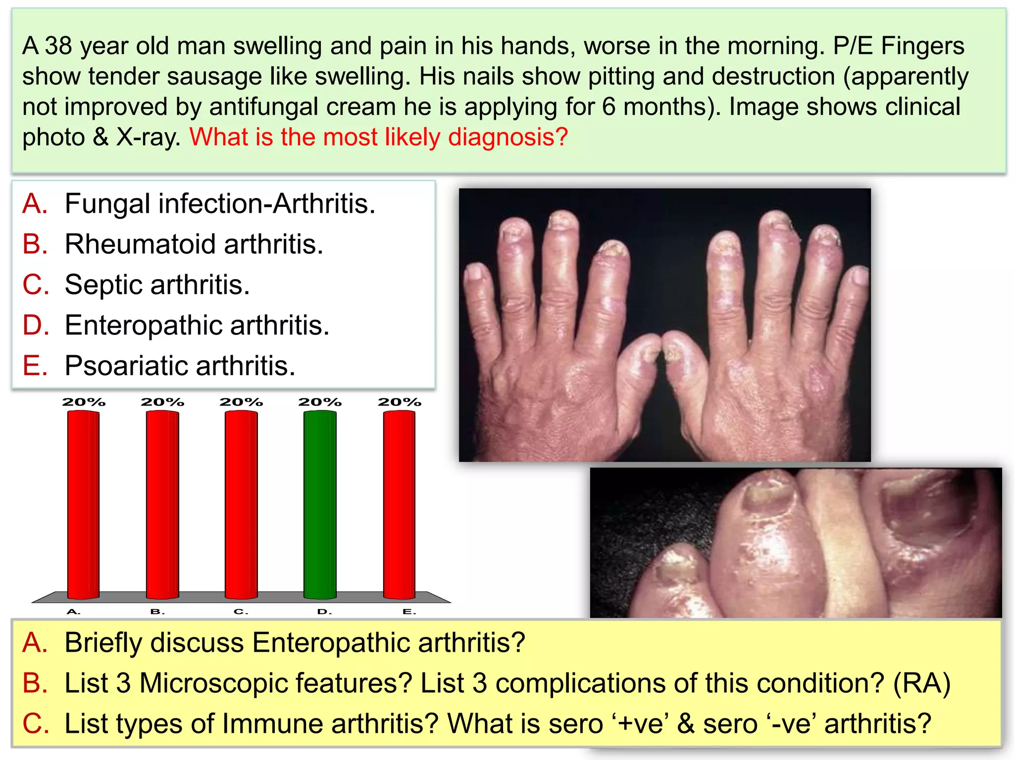 A 38 year old man swelling and pain in his hands, worse in the morning. P/E Fingers show tender sausage like swelling. His nails show pitting and destruction (apparently not improved by antifungal cream he is applying for 6 months). Image shows clinical photo & X-ray. What is the most likely diagnosis?Fungal infection-Arthritis.Rheumatoid arthritis.Septic arthritis.Enteropathic arthritis.Psoariatic arthritis.Briefly discuss Enteropathic arthritis?List 3 Microscopic features? List 3 complications of this condition? (RA)List types of Immune arthritis? What is sero ‘+ve’ & sero ‘-ve’ arthritis?