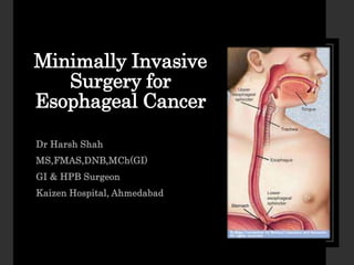 Minimally Invasive
Surgery for
Esophageal Cancer
Dr Harsh Shah
MS,FMAS,DNB,MCh(GI)
GI & HPB Surgeon
Kaizen Hospital, Ahmedabad
 