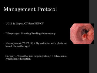 Management Protocol
• UGIE & Biopsy, CT Scan/PET-CT
• ? Esophageal Stenting/Feeding Jejunostomy
• Neo-adjuvant CT-RT (50.4 Gy radiation with platinum
based chemotherapy)
• Surgery – Transthoracic esophagectomy + Infracarinal
lymph node dissection
 