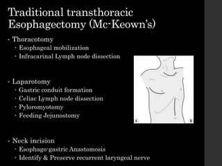 Traditional transthoracic
Esophagectomy (Mc-Keown’s)
• Thoracotomy
 Esophageal mobilization
 Infracarinal Lymph node dissection
• Laparotomy
 Gastric conduit formation
 Celiac Lymph node dissection
 Pyloromyotomy
 Feeding Jejunostomy
• Neck incision
 Esophago-gastric Anastomosis
 Identify & Preserve recurrent laryngeal nerve
 