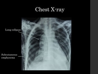 Chest X-ray
Lung collpase
Subcutaneous
emphysema
 