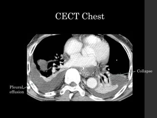CECT Chest
Collapse
Pleural
effusion
 