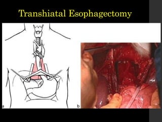 Transhiatal Esophagectomy
 