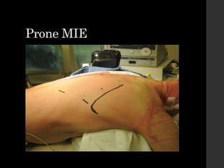 Prone MIE
 