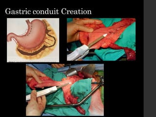 Gastric conduit Creation
 