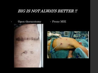 BIG IS NOT ALWAYS BETTER !!
• Open thoracotomy • Prone MIE
 