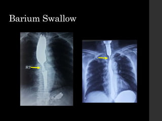 Barium Swallow
 