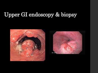 Upper GI endoscopy & biopsy
 
