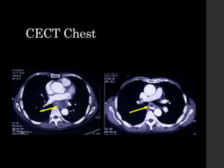 CECT Chest
 