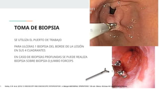 TOMA DE BIOPSIA
SE UTILIZA EL PUERTO DE TRABAJO
PARA ULCERAS 1 BIOPSIA DEL BORDE DE LA LESIÓN
EN SUS 4 CUADRANTES
EN CASO DE BIOPSIAS PROFUNDAS SE PUEDE REALIZA
BIOPSIA SOBRE BIOPSIA O JUMBO FORCEPS
1. Ashley, S.W. et al. (2019) ‘5: ENDOSCOPY AND ENDOSCOPIC INTERVENTION’, in Maingot ABDOMINAL OPERATIONS. 13th edn. México: McGraw-Hill Interamericana Editores.
 