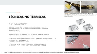 TÉCNICAS NO TÉRMICAS
CLIPS ENDOSCÓPICOS
GENERALMENTE SE REQUIEREN MÁS DE 1 PARA
HEMOSTASIA,
HEMOSTASIA SUPERFICIAL SOLO TOMA MUCOSA
SE PUEDEN USAR CLIPS DE 2 O 3 BRAZOS SE CAEN DE LOS
TEJIDOS 1 A 2 SEMANAS.
EFICACIA 71 A 100% CONTROL HEMOSTÁTICO
1. Ashley, S.W. et al. (2019) ‘5: ENDOSCOPY AND ENDOSCOPIC INTERVENTION’, in Maingot ABDOMINAL OPERATIONS. 13th edn. México: McGraw-Hill Interamericana Editores.
 