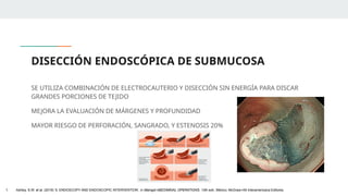 DISECCIÓN ENDOSCÓPICA DE SUBMUCOSA
SE UTILIZA COMBINACIÓN DE ELECTROCAUTERIO Y DISECCIÓN SIN ENERGÍA PARA DISCAR
GRANDES PORCIONES DE TEJIDO
MEJORA LA EVALUACIÓN DE MÁRGENES Y PROFUNDIDAD
MAYOR RIESGO DE PERFORACIÓN, SANGRADO, Y ESTENOSIS 20%
1. Ashley, S.W. et al. (2019) ‘5: ENDOSCOPY AND ENDOSCOPIC INTERVENTION’, in Maingot ABDOMINAL OPERATIONS. 13th edn. México: McGraw-Hill Interamericana Editores.
 