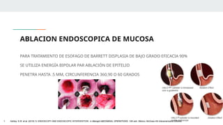 ABLACION ENDOSCOPICA DE MUCOSA
PARA TRATAMIENTO DE ESOFAGO DE BARRETT DISPLASIA DE BAJO GRADO EFICACIA 90%
SE UTILIZA ENERGÍA BIPOLAR PAR ABLACIÓN DE EPITELIO
PENETRA HASTA .5 MM, CIRCUNFERENCIA 360,90 O 60 GRADOS
1. Ashley, S.W. et al. (2019) ‘5: ENDOSCOPY AND ENDOSCOPIC INTERVENTION’, in Maingot ABDOMINAL OPERATIONS. 13th edn. México: McGraw-Hill Interamericana Editores.
 
