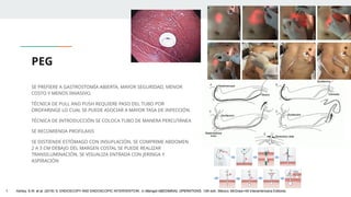PEG
SE PREFIERE A GASTROSTOMÍA ABIERTA, MAYOR SEGURIDAD, MENOR
COSTO Y MENOS INVASIVO.
TÉCNICA DE PULL AND PUSH REQUIERE PASO DEL TUBO POR
OROFARINGE LO CUAL SE PUEDE ASOCIAR A MAYOR TASA DE INFECCIÓN.
TÉCNICA DE INTRODUCCIÓN SE COLOCA TUBO DE MANERA PERCUTÁNEA
SE RECOMIENDA PROFILAXIS
SE DISTIENDE ESTÓMAGO CON INSUFLACIÓN, SE COMPRIME ABDOMEN
2 A 3 CM DEBAJO DEL MARGEN COSTAL SE PUEDE REALIZAR
TRANSILUMINACIÓN, SE VISUALIZA ENTRADA CON JERINGA Y
ASPIRACIÓN
1. Ashley, S.W. et al. (2019) ‘5: ENDOSCOPY AND ENDOSCOPIC INTERVENTION’, in Maingot ABDOMINAL OPERATIONS. 13th edn. México: McGraw-Hill Interamericana Editores.
 