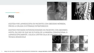 PEG
ASISTIDA POR LAPAROSCOPIA EN PACIENTES CON OBESIDAD MÓRBIDA,
PREVIO A CIRUGÍA O ESTÓMAGO INTRATORÁCICO
ASISTIDO POR RADIO INTERVENCIONISMO EN PACIENTES CON ABDOMEN
HOSTIL EN CASO DE QUE NO SE PUEDA DE LA MANERA CONVENCIONAL O
LAPAROSCÓPICAMENTE. COLOCA CATÉTER COLA DE COCHINO CON
TÉCNICA RENDEVOUZ
1. Ashley, S.W. et al. (2019) ‘5: ENDOSCOPY AND ENDOSCOPIC INTERVENTION’, in Maingot ABDOMINAL OPERATIONS. 13th edn. México: McGraw-Hill Interamericana Editores.
 