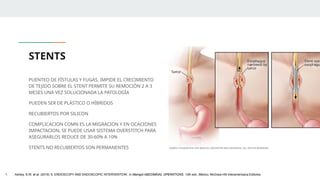 STENTS
PUENTEO DE FÍSTULAS Y FUGAS, IMPIDE EL CRECIMIENTO
DE TEJIDO SOBRE EL STENT PERMITE SU REMOCIÓN 2 A 3
MESES UNA VEZ SOLUCIONADA LA PATOLOGÍA
PUEDEN SER DE PLÁSTICO O HÍBRIDOS
RECUBIERTOS POR SILICON
COMPLICACION COMN ES LA MIGRACION Y EN OCACIONES
IMPACTACION, SE PUEDE USAR SISTEMA OVERSTITCH PARA
ASEGURARLOS REDUCE DE 30-60% A 10%
STENTS NO RECUBIERTOS SON PERMANENTES
1. Ashley, S.W. et al. (2019) ‘5: ENDOSCOPY AND ENDOSCOPIC INTERVENTION’, in Maingot ABDOMINAL OPERATIONS. 13th edn. México: McGraw-Hill Interamericana Editores.
 