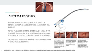 SISTEMA ESOPHYX
IMITA FUNDUPLICATURA CON PLICACIONES DE
SEROSA-SEROSA, ENVUELVE FONDO ALREDEDOR DEL
CARDIAS
TIF 1.0 PLICACION GASTRO-GÁSTRICA EN LÍNEA Z, TIF
2.0 CREA VALVULA 3 A 4CM DESDE ARRIBA DE LIENA Z
Y PLICACION ESOFAGO-GASTRICA 270 A 210 GRADOS
SE REQUIERE 2 OPERADORES UNO PARA ENDOSCOPIO
Y OTRO PARA EL ESOPHYX
1. Ashley, S.W. et al. (2019) ‘5: ENDOSCOPY AND ENDOSCOPIC INTERVENTION’, in Maingot ABDOMINAL OPERATIONS. 13th edn. México: McGraw-Hill Interamericana Editores.
 