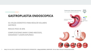 GASTROPLASTIA ENDOSCOPICA
SE UTILIZA OVERSTITCH PARA REDUCIR VOLUMEN
GÁSTRICO
REDUCE PESO 30-40%
COMPLICACIONES RARAS COMO ABSCESOS,
SANGRADO Y LESIÓN ESPLÉNICA
1. Ashley, S.W. et al. (2019) ‘5: ENDOSCOPY AND ENDOSCOPIC INTERVENTION’, in Maingot ABDOMINAL OPERATIONS. 13th edn. México: McGraw-Hill Interamericana Editores.
 