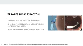TERAPIA DE ASPIRACIÓN
APROBADA PARA PACIENTES IMC 35-55 KG/M2
SE COLOCA PEG Y SE ELIMINA 30% COMIDA 30 MIN
POSTERIOR A SU INGESTA
SE UTILIZA BOMBA DE SUCCIÓN CONECTADA A PEG
1. Ashley, S.W. et al. (2019) ‘5: ENDOSCOPY AND ENDOSCOPIC INTERVENTION’, in Maingot ABDOMINAL OPERATIONS. 13th edn. México: McGraw-Hill Interamericana Editores.
 