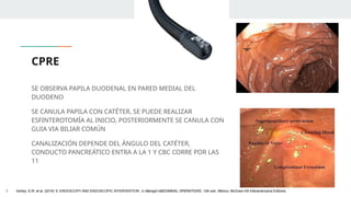 CPRE
SE OBSERVA PAPILA DUODENAL EN PARED MEDIAL DEL
DUODENO
SE CANULA PAPILA CON CATÉTER, SE PUEDE REALIZAR
ESFINTEROTOMÍA AL INICIO, POSTERIORMENTE SE CANULA CON
GUIA VIA BILIAR COMÚN
CANALIZACIÓN DEPENDE DEL ÁNGULO DEL CATÉTER,
CONDUCTO PANCREÁTICO ENTRA A LA 1 Y CBC CORRE POR LAS
11
1. Ashley, S.W. et al. (2019) ‘5: ENDOSCOPY AND ENDOSCOPIC INTERVENTION’, in Maingot ABDOMINAL OPERATIONS. 13th edn. México: McGraw-Hill Interamericana Editores.
 