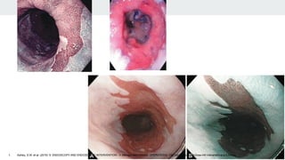 1. Ashley, S.W. et al. (2019) ‘5: ENDOSCOPY AND ENDOSCOPIC INTERVENTION’, in Maingot ABDOMINAL OPERATIONS. 13th edn. México: McGraw-Hill Interamericana Editores.
 