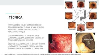 TÉCNICA
PARA SALIR DEL COLON SIGMOIDE SE DEBE
ADQUIRIR UN LOOP EL CUAL SE VA A REDUCIR
RETIRANDO UN POCO EL ENDOSCOPIO Y
REALIZANDO TORQUE
COLON TRANSVERSO SE IDENTIFICA POR
LUMEN TRIANGULAR, SE OBSERVA SOMBRA EN
ÁNGULO ESPLÉNICO Y HEPÁTICO
OBJETIVO ES LLEGAR HASTA EL CIEGO Y RETIRAR
LENTAMENTE EVALUANDO TODA LA MUCOSA,
SE REALIZA RETROFLEXION EN EL CANAL ANAL
1. Ashley, S.W. et al. (2019) ‘5: ENDOSCOPY AND ENDOSCOPIC INTERVENTION’, in Maingot ABDOMINAL OPERATIONS. 13th edn. México: McGraw-Hill Interamericana Editores.
 