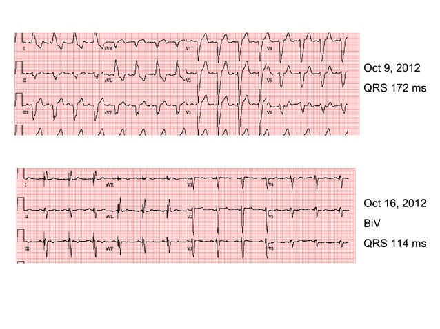 Qrs And Crt Final In English PPT qrs-and-crt-final-in-english-ppt