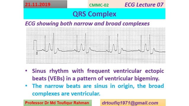 ECG -QRS complex | PPTX | Heart and Cardiovascular Diseases | Diseases ...
