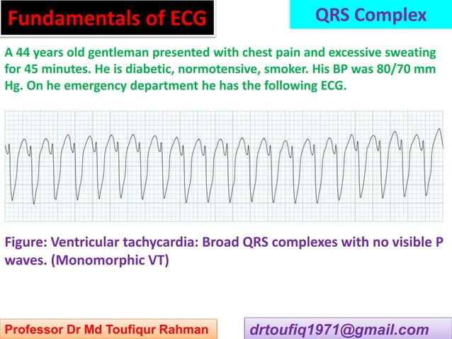 Approach to a patient with QRS complex abnormality in ECG | PPT