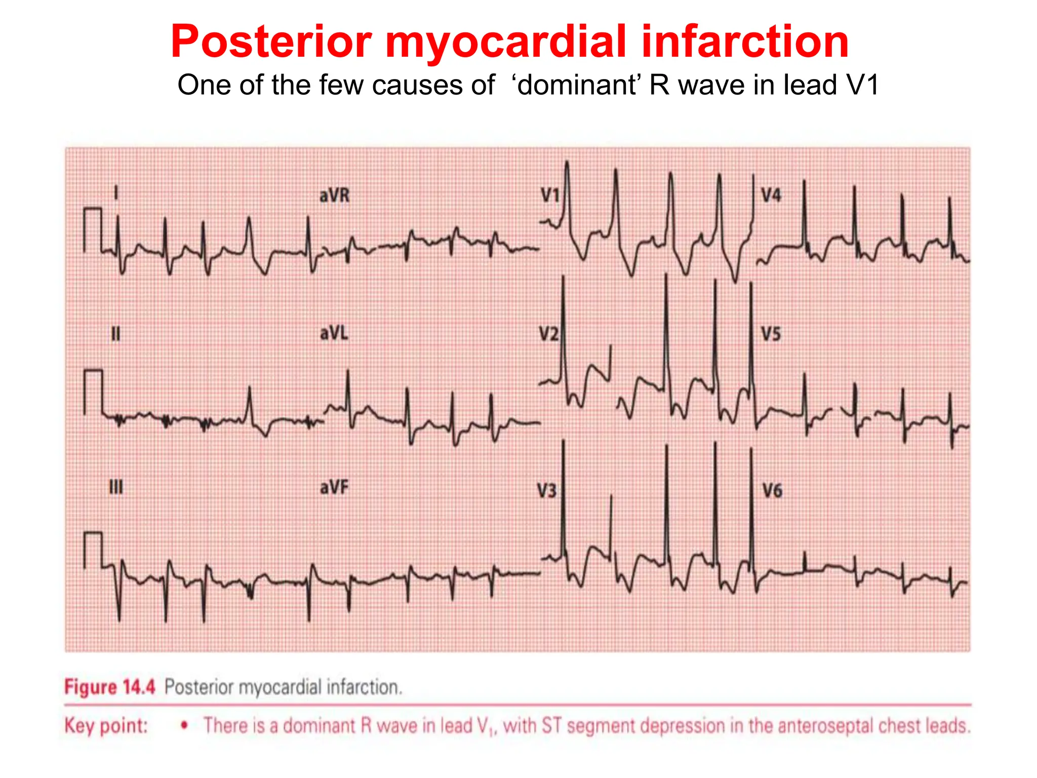 Posterior myocardial infarction
One of the few causes of ‘dominant’ R wave in lead V1
 