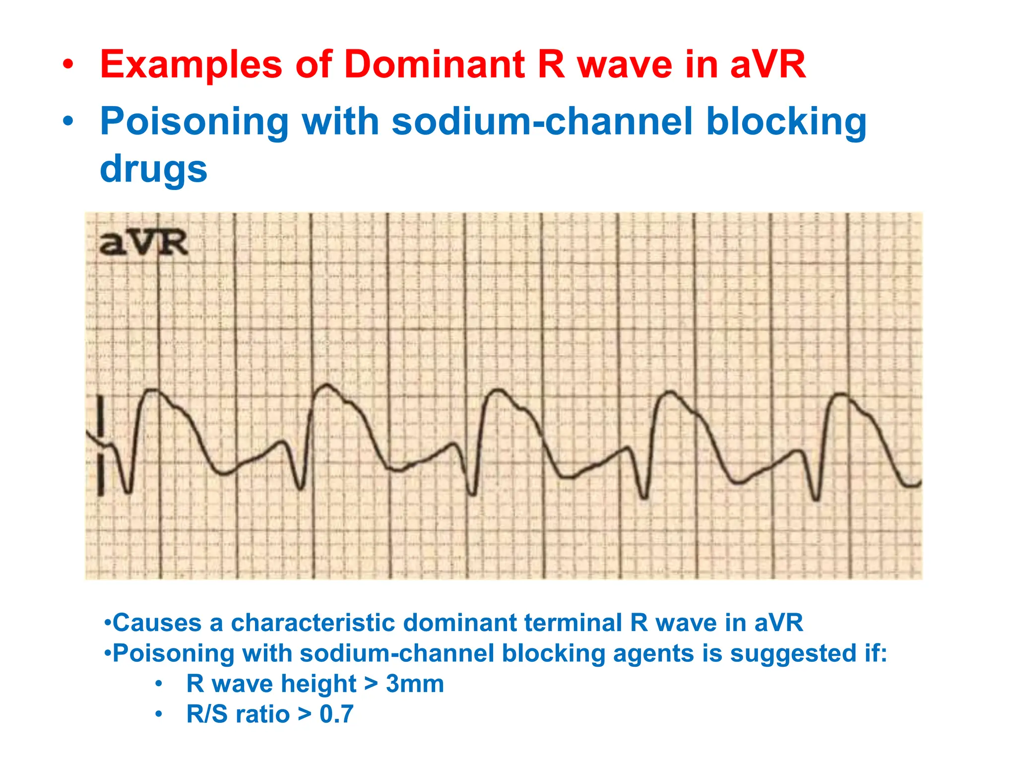 • Examples of Dominant R wave in aVR
• Poisoning with sodium-channel blocking
drugs
•Causes a characteristic dominant terminal R wave in aVR
•Poisoning with sodium-channel blocking agents is suggested if:
• R wave height > 3mm
• R/S ratio > 0.7
 