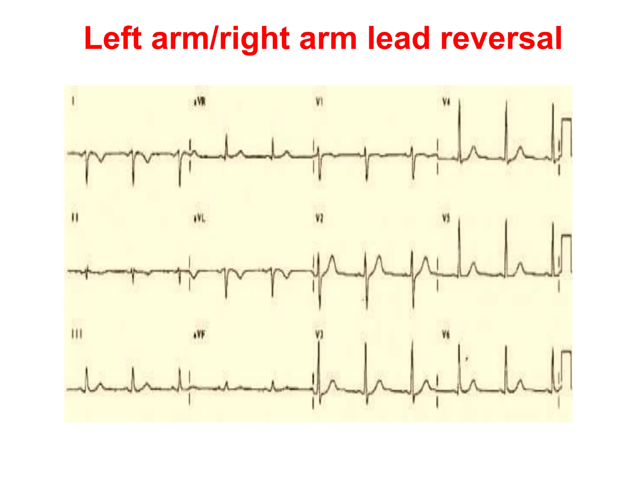 Left arm/right arm lead reversal
 