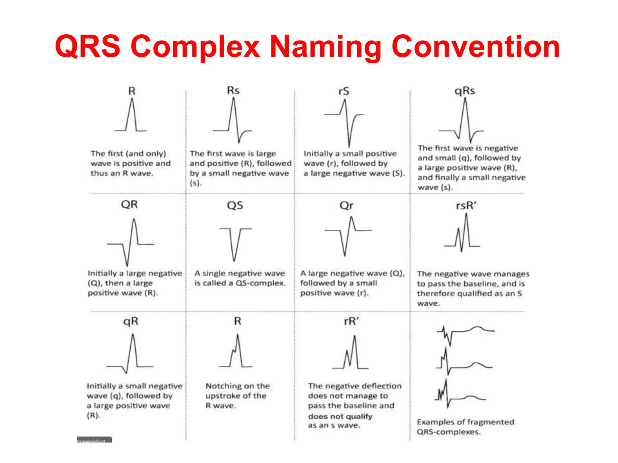 QRS Complex Naming Convention
 