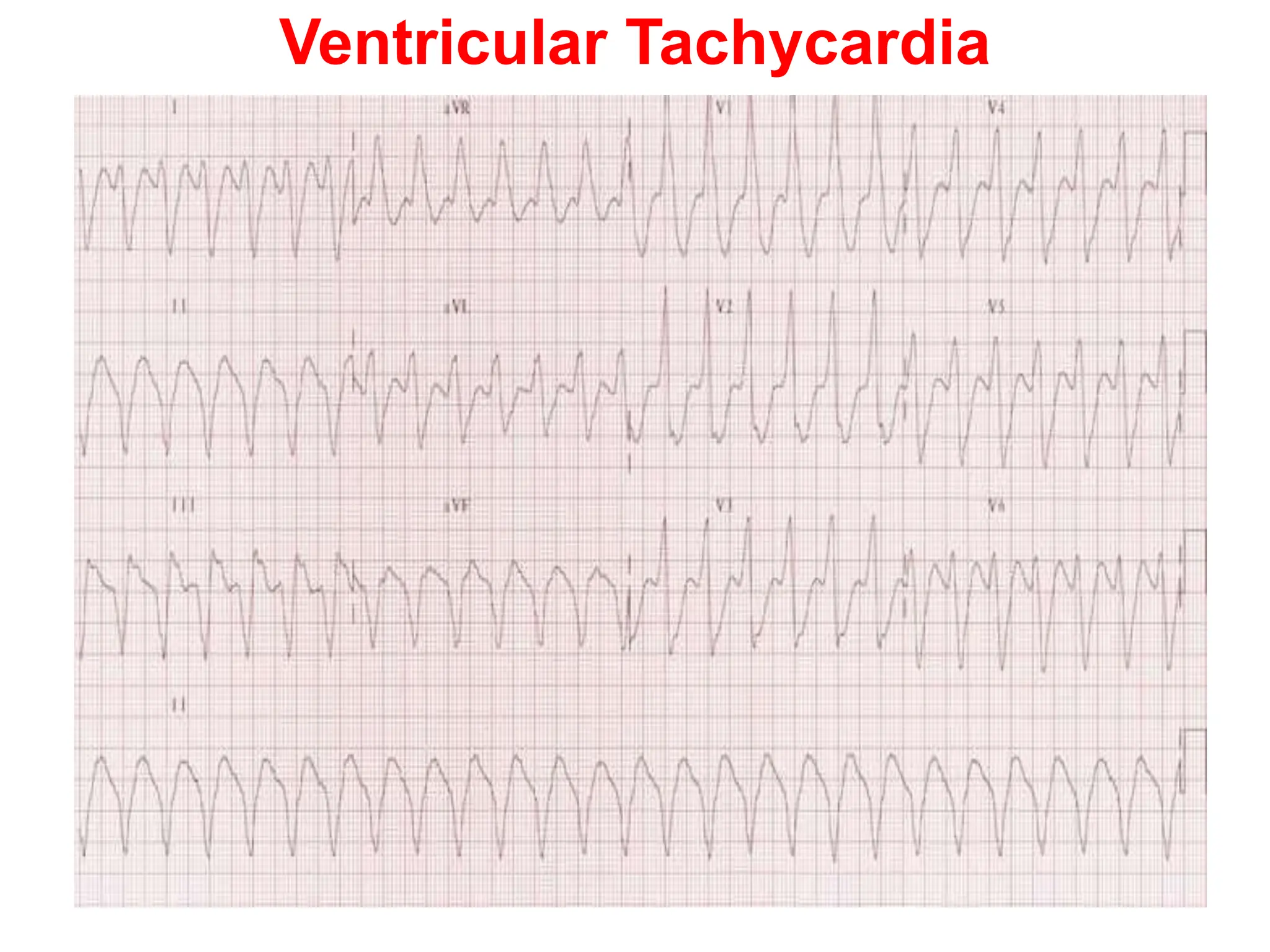 Ventricular Tachycardia
 