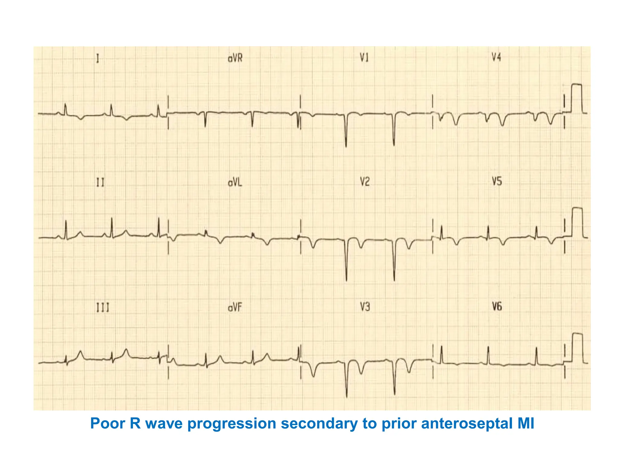 Poor R wave progression secondary to prior anteroseptal MI
 