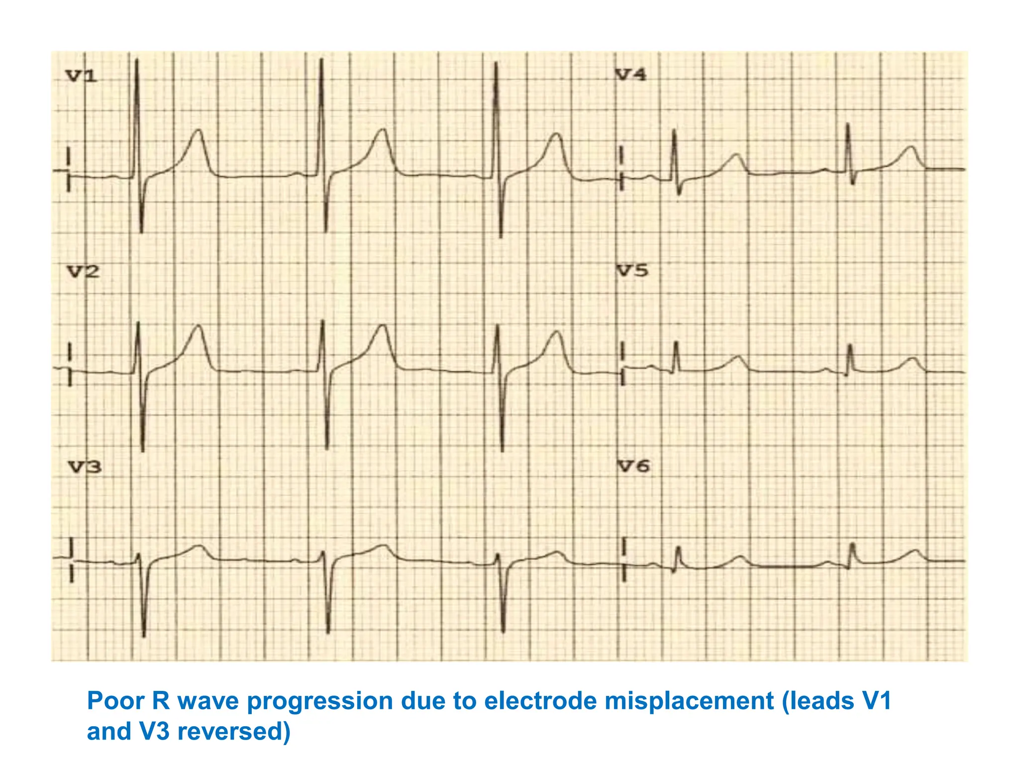 Poor R wave progression due to electrode misplacement (leads V1
and V3 reversed)
 