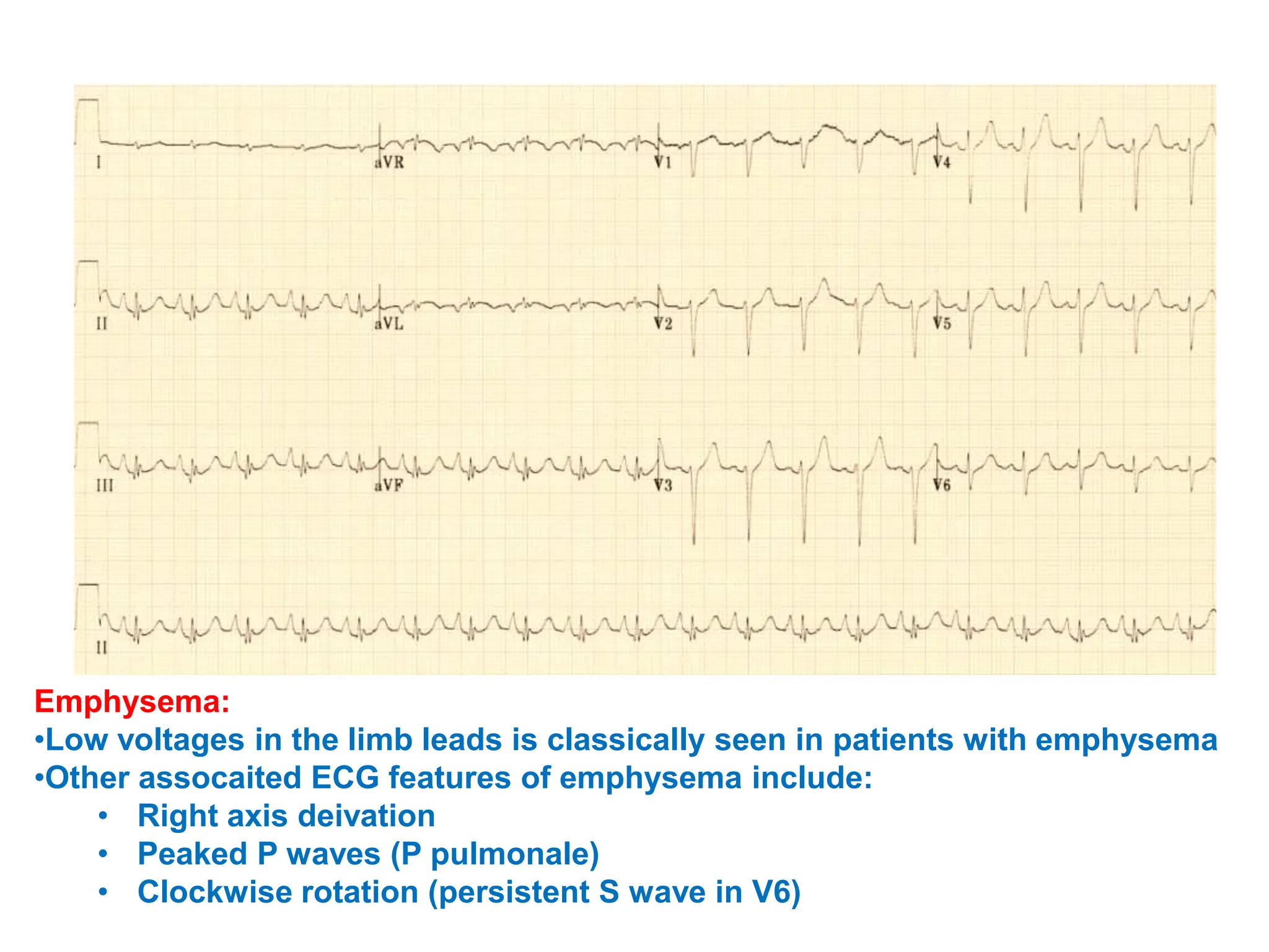 Emphysema:
•Low voltages in the limb leads is classically seen in patients with emphysema
•Other assocaited ECG features of emphysema include:
• Right axis deivation
• Peaked P waves (P pulmonale)
• Clockwise rotation (persistent S wave in V6)
 