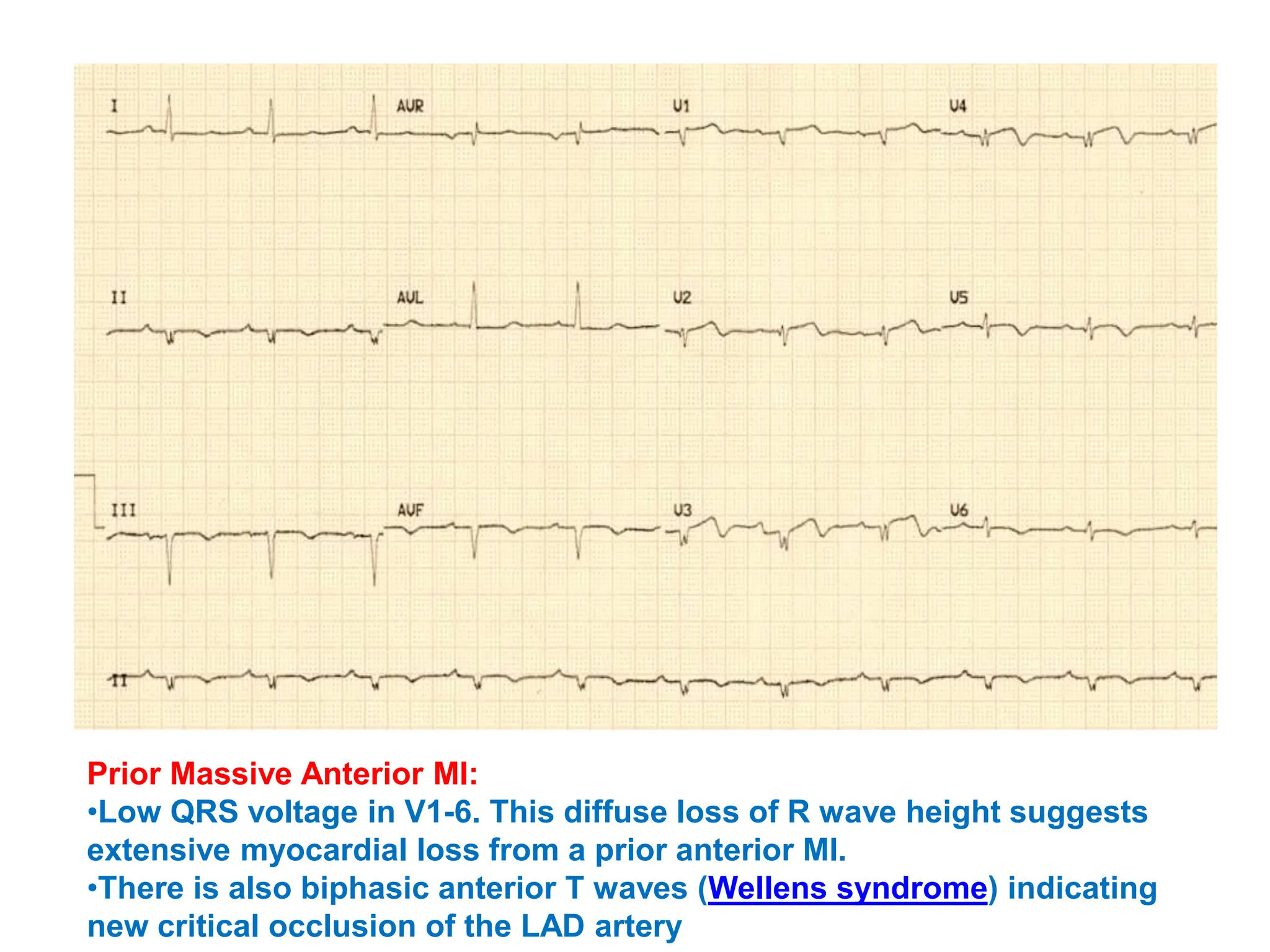 Prior Massive Anterior MI:
•Low QRS voltage in V1-6. This diffuse loss of R wave height suggests
extensive myocardial loss from a prior anterior MI.
•There is also biphasic anterior T waves (Wellens syndrome) indicating
new critical occlusion of the LAD artery
 
