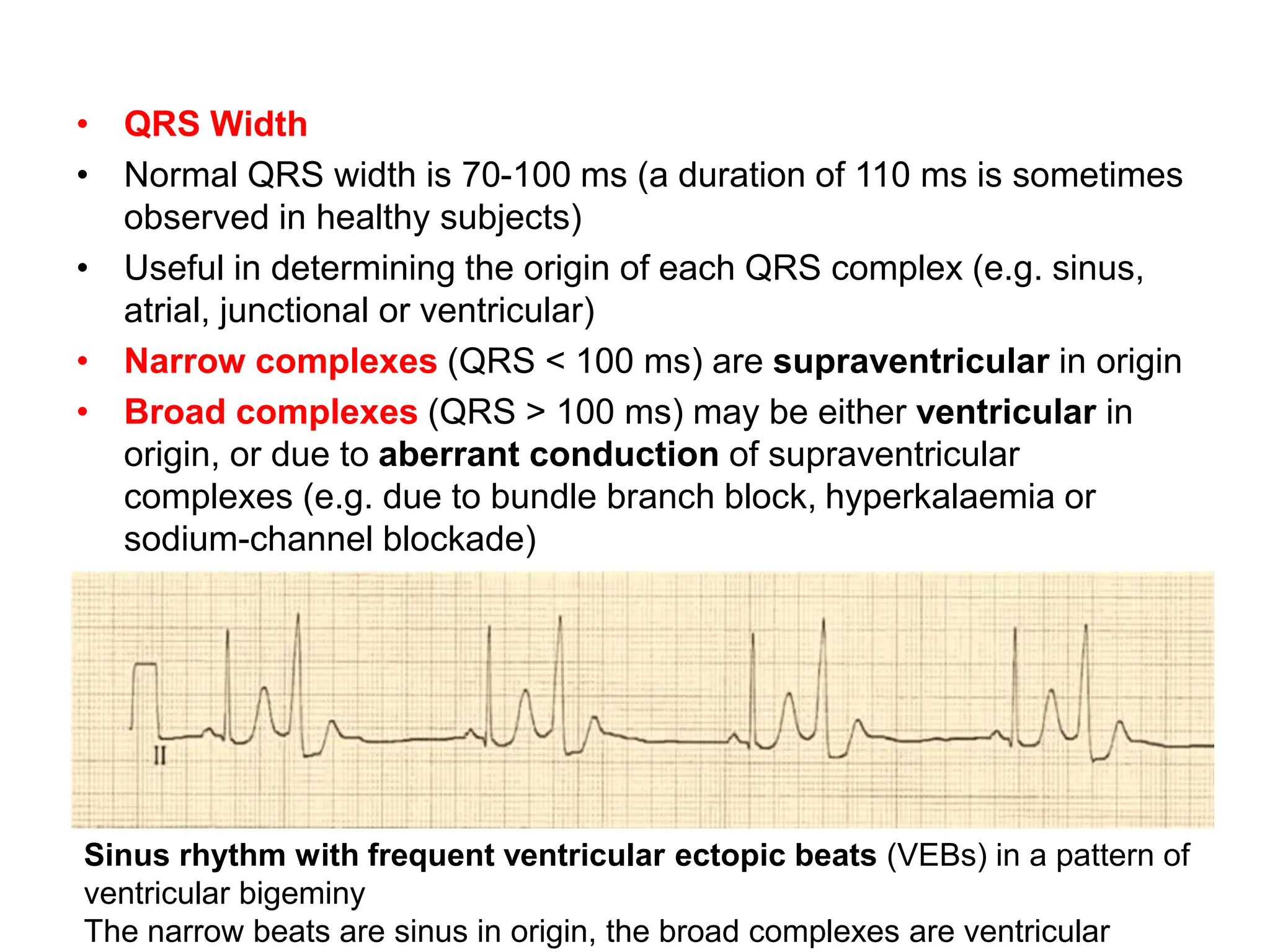 • QRS Width
• Normal QRS width is 70-100 ms (a duration of 110 ms is sometimes
observed in healthy subjects)
• Useful in determining the origin of each QRS complex (e.g. sinus,
atrial, junctional or ventricular)
• Narrow complexes (QRS < 100 ms) are supraventricular in origin
• Broad complexes (QRS > 100 ms) may be either ventricular in
origin, or due to aberrant conduction of supraventricular
complexes (e.g. due to bundle branch block, hyperkalaemia or
sodium-channel blockade)
Sinus rhythm with frequent ventricular ectopic beats (VEBs) in a pattern of
ventricular bigeminy
The narrow beats are sinus in origin, the broad complexes are ventricular
 