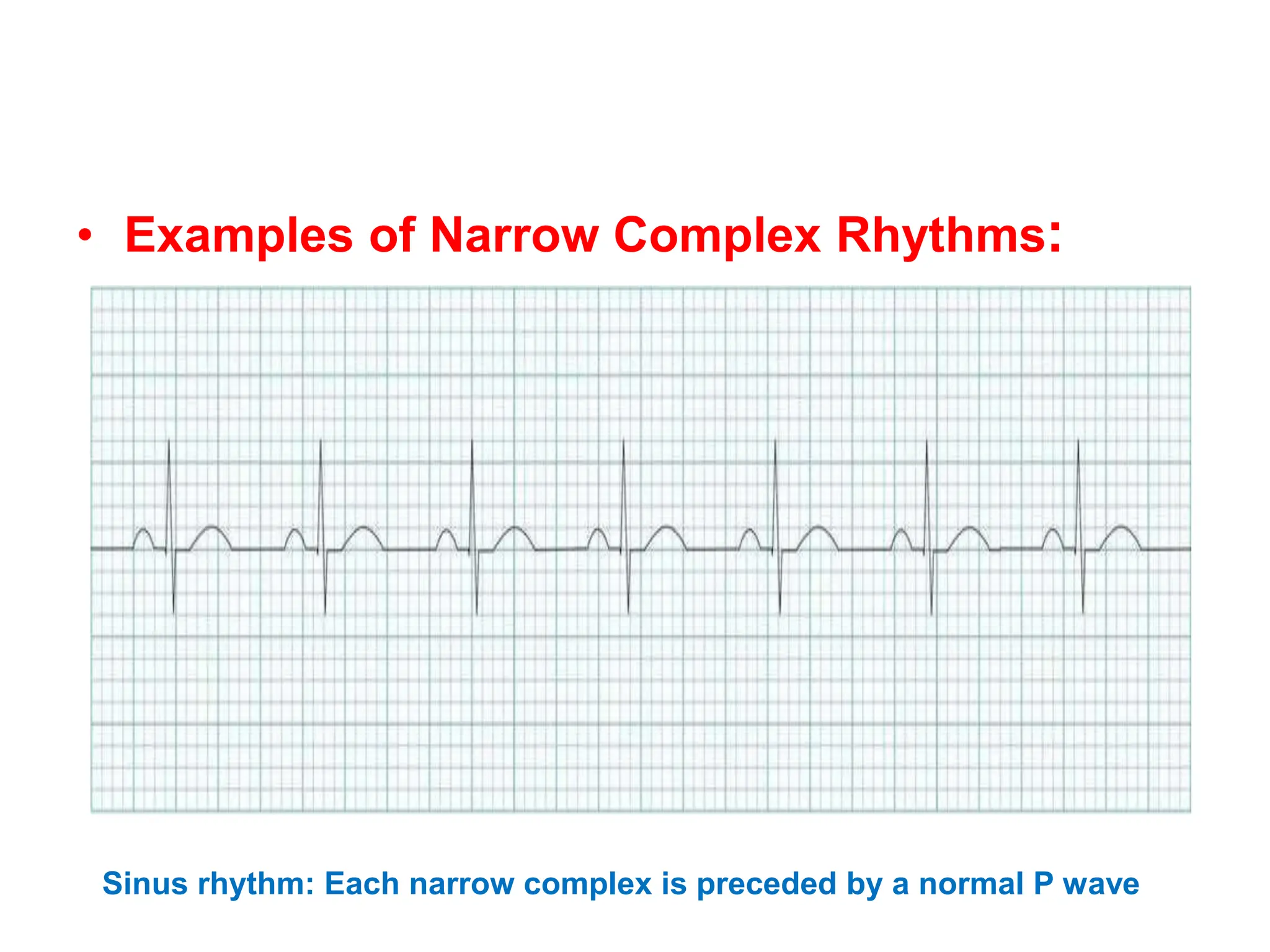 • Examples of Narrow Complex Rhythms:
Sinus rhythm: Each narrow complex is preceded by a normal P wave
 