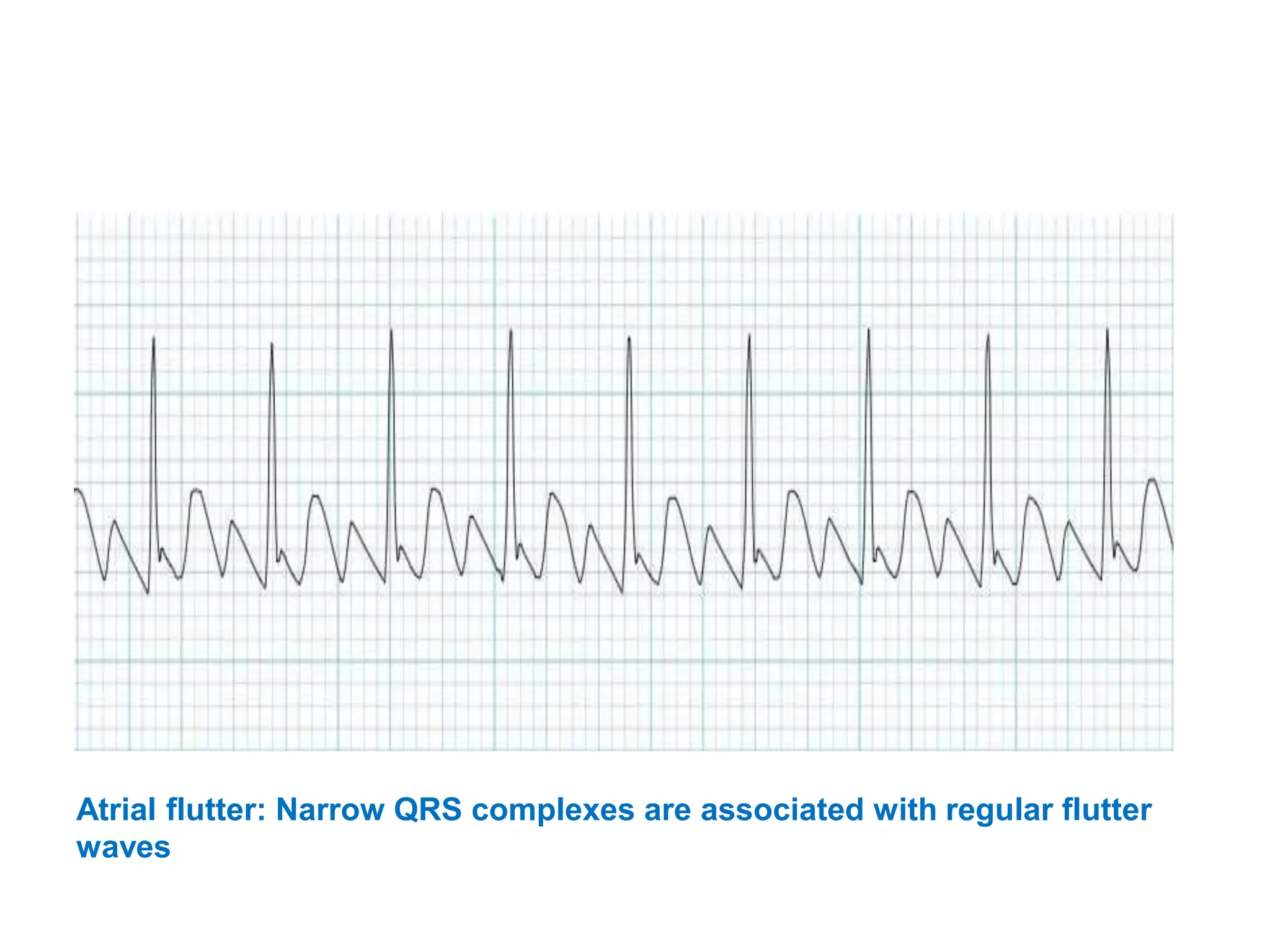 Atrial flutter: Narrow QRS complexes are associated with regular flutter
waves
 