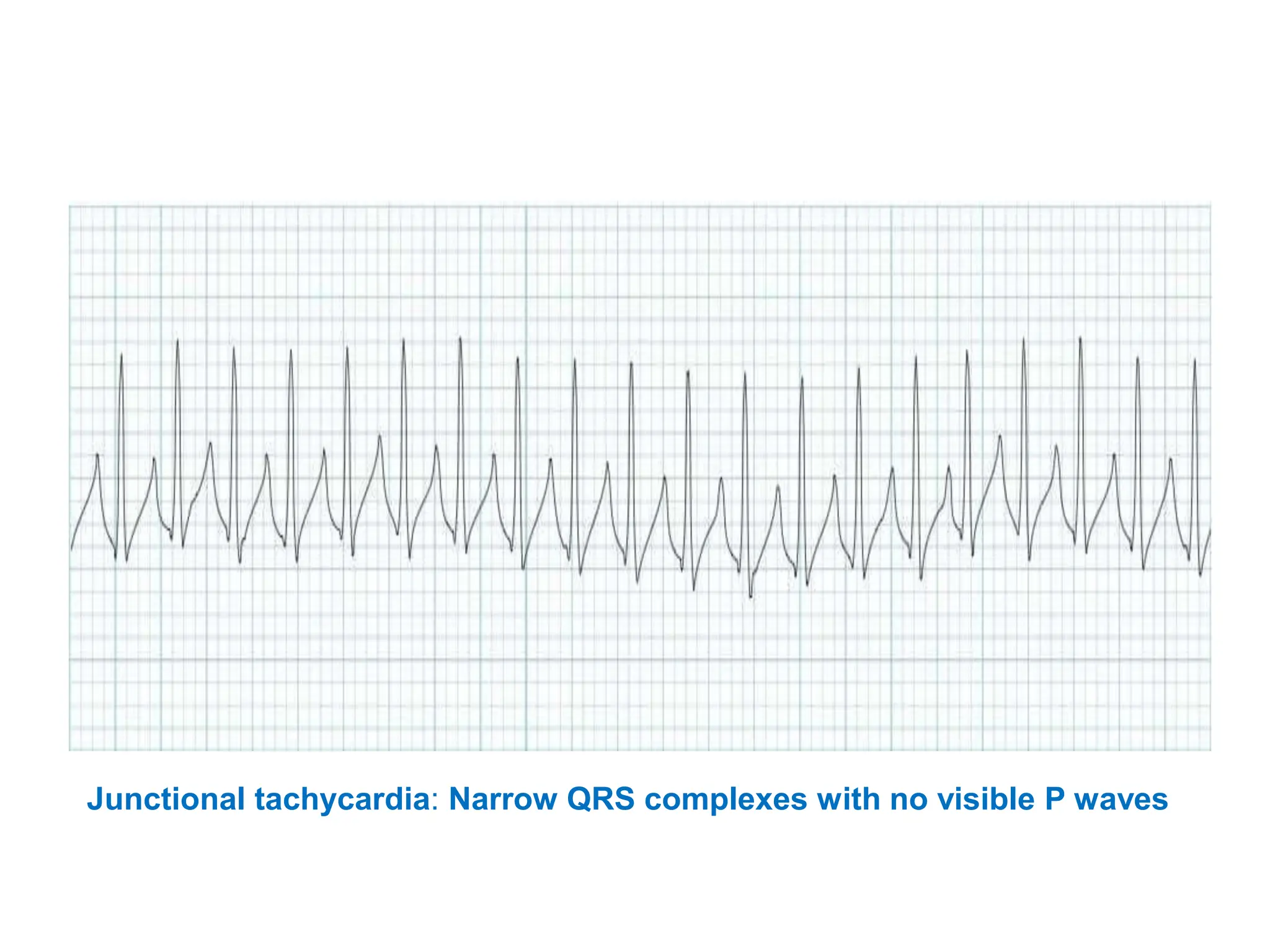 Junctional tachycardia: Narrow QRS complexes with no visible P waves
 