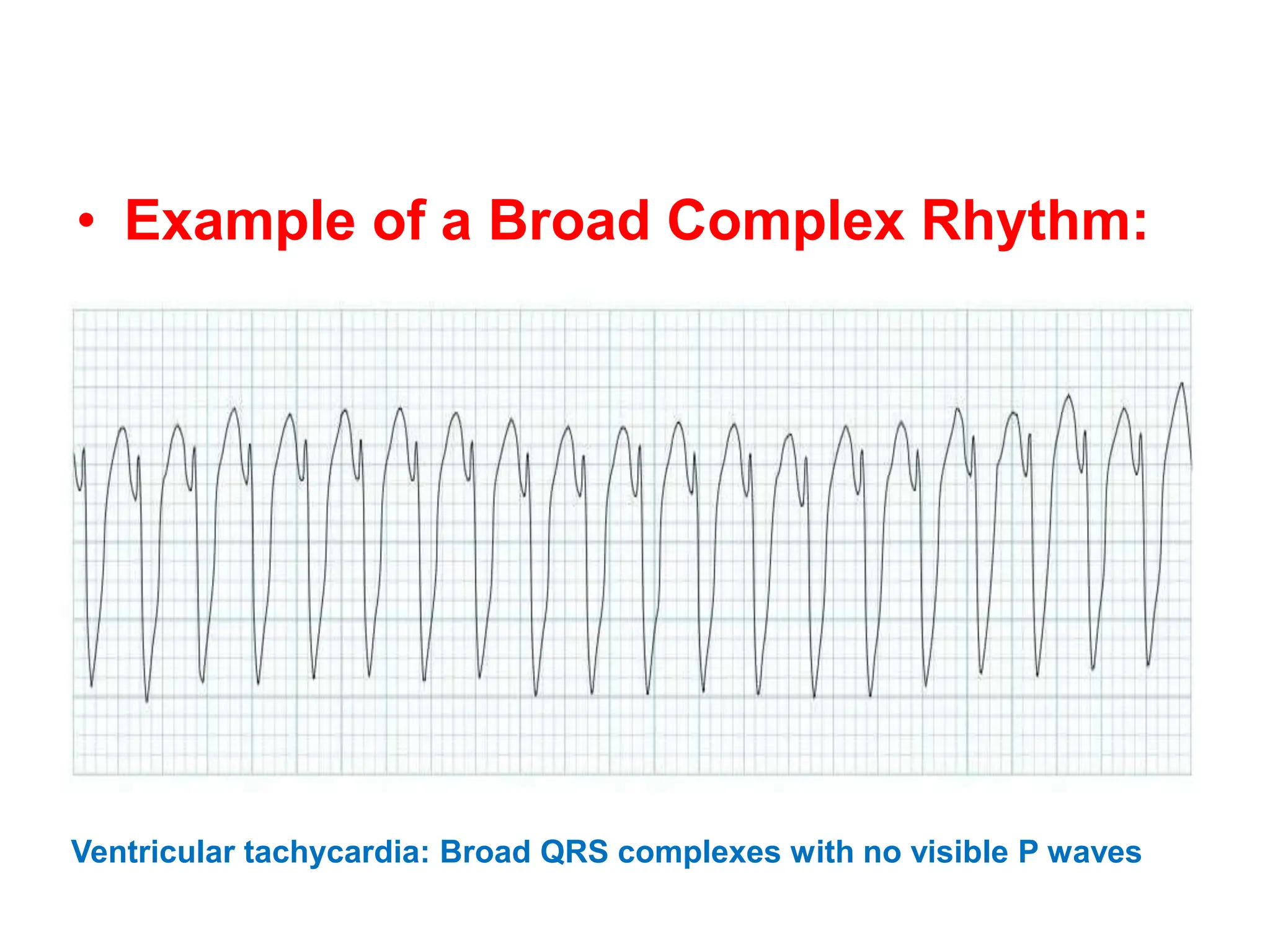 • Example of a Broad Complex Rhythm:
Ventricular tachycardia: Broad QRS complexes with no visible P waves
 