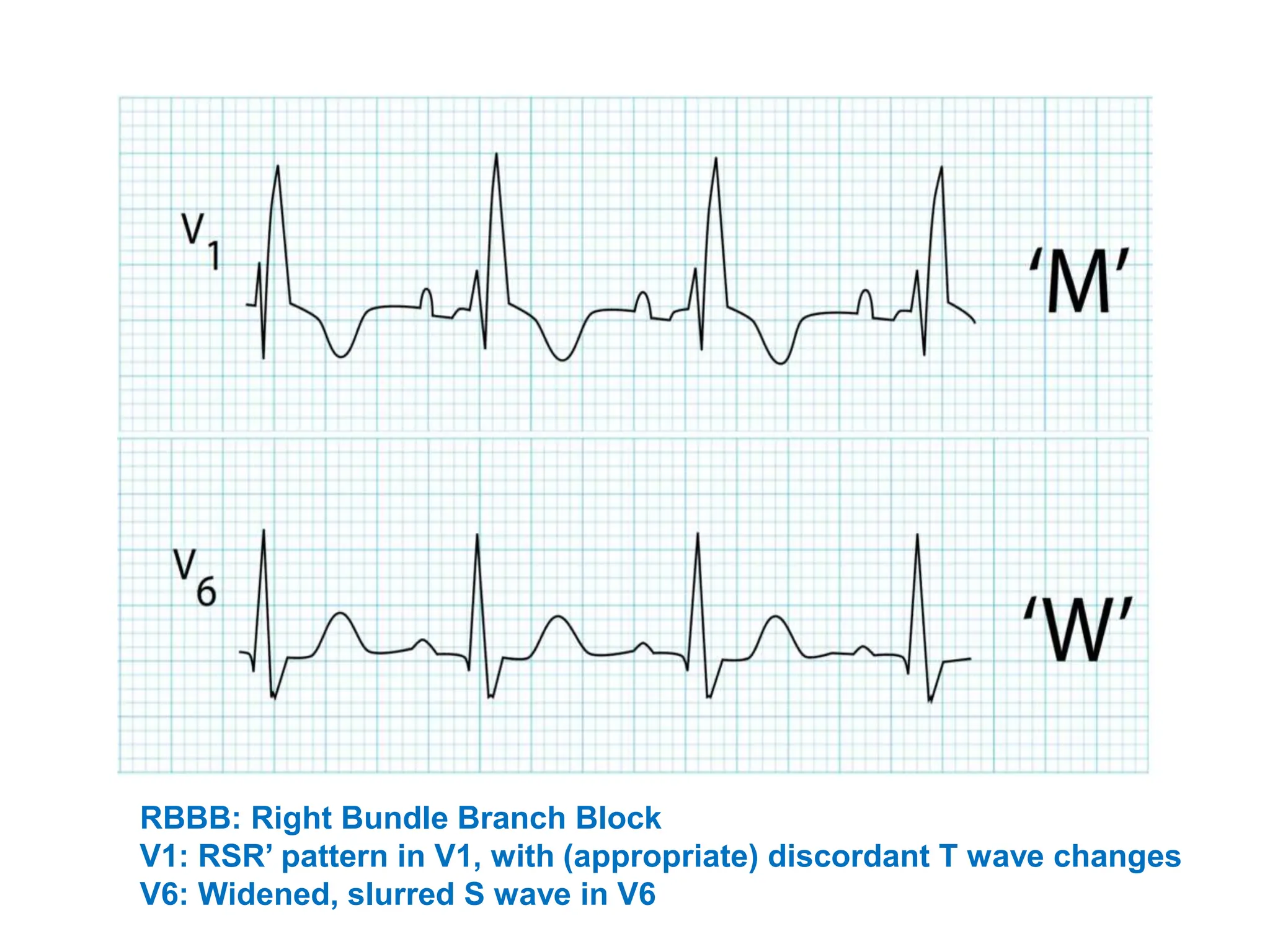 RBBB: Right Bundle Branch Block
V1: RSR’ pattern in V1, with (appropriate) discordant T wave changes
V6: Widened, slurred S wave in V6
 