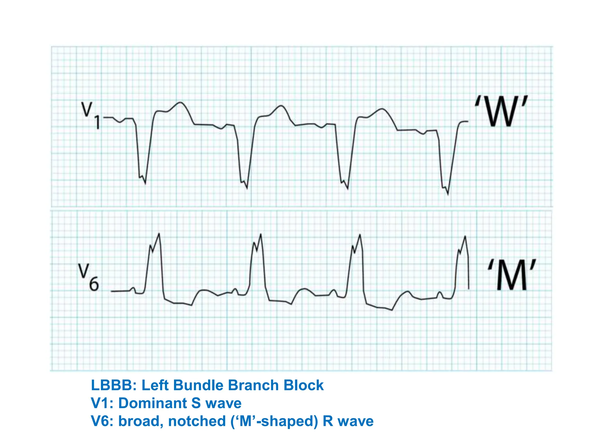 LBBB: Left Bundle Branch Block
V1: Dominant S wave
V6: broad, notched (‘M’-shaped) R wave
 