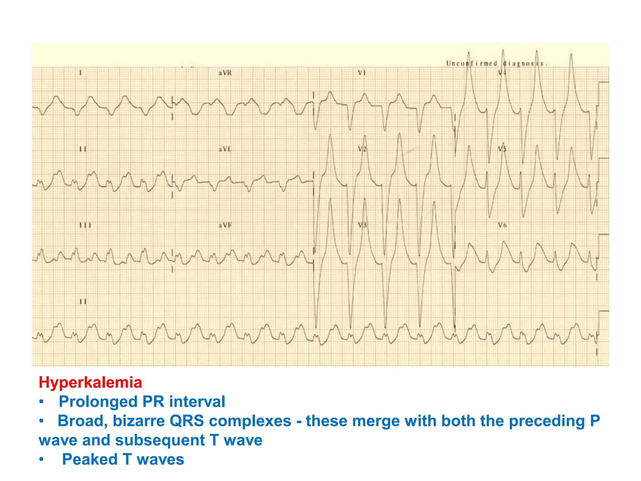 Hyperkalemia
• Prolonged PR interval
• Broad, bizarre QRS complexes - these merge with both the preceding P
wave and subsequent T wave
• Peaked T waves
 