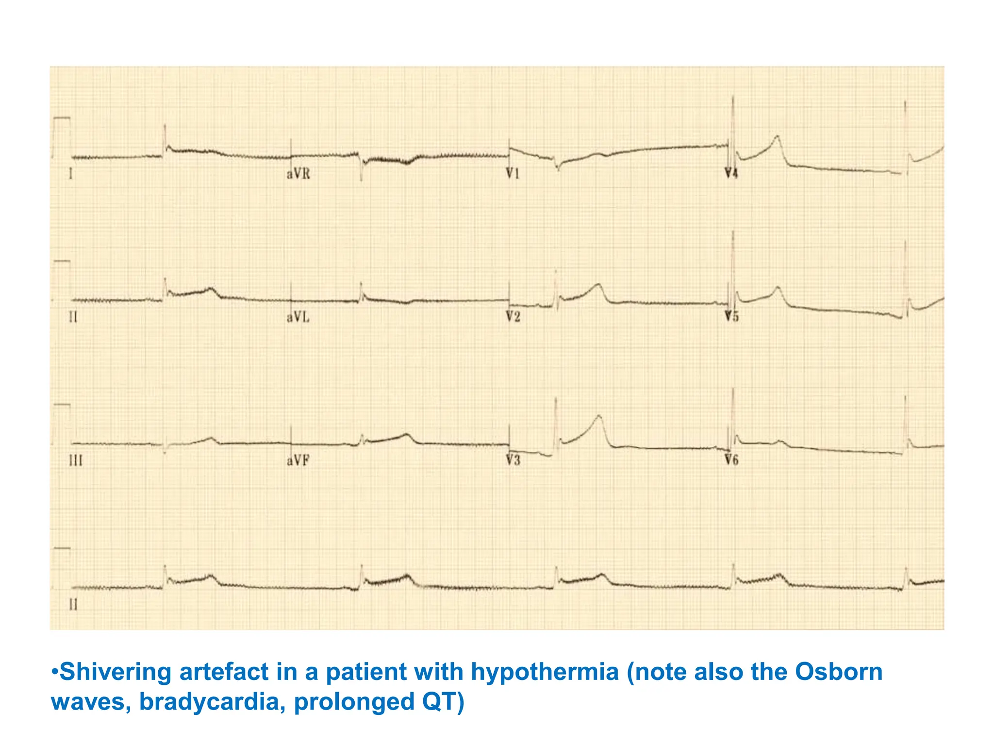 •Shivering artefact in a patient with hypothermia (note also the Osborn
waves, bradycardia, prolonged QT)
 